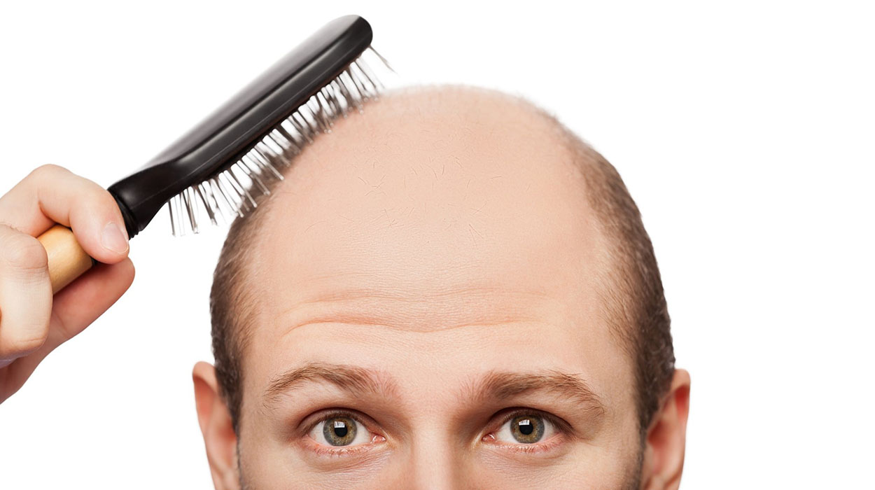 Erkek Tipi Saç Dökülmesi Nedir?