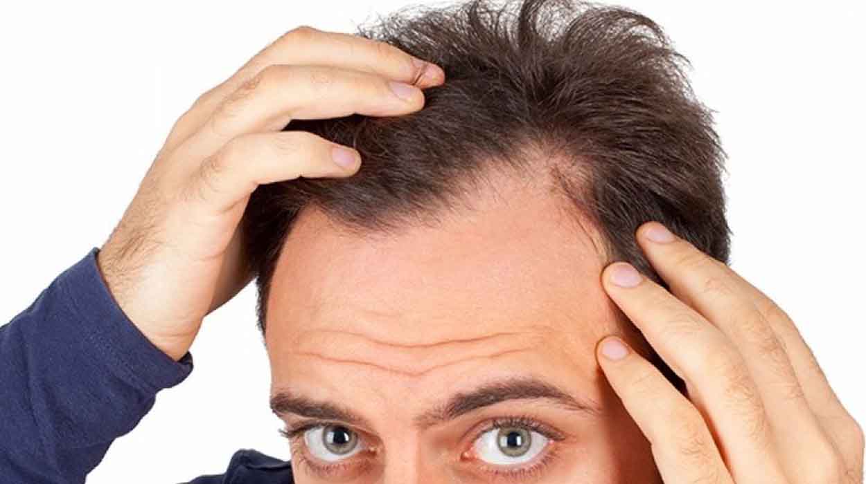 Erkeklerde Saç Dökülmesi Nasıl Önlenir?