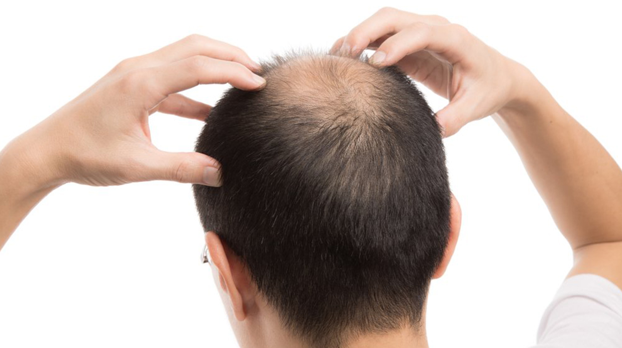 Erkeklerde Saç Dökülmesine Ne İyi Gelir? Nasıl Önlenir?